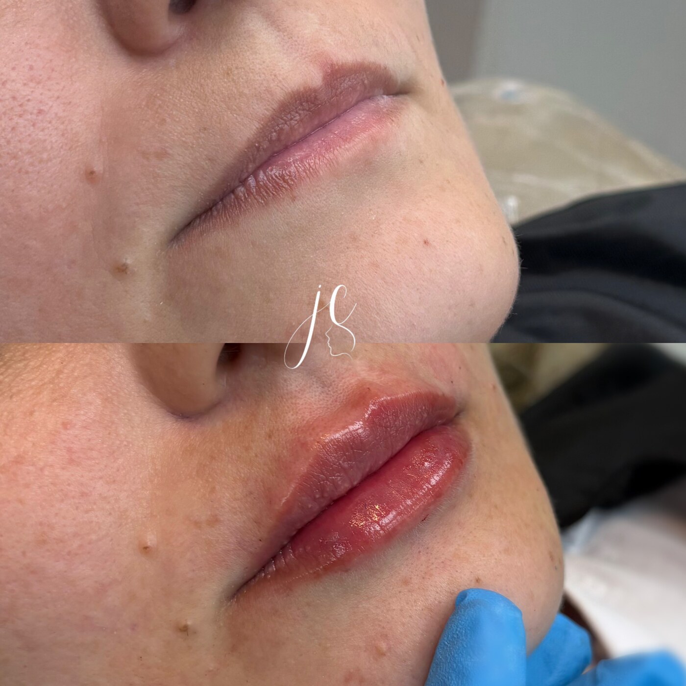 Antes e depois de preenchimento labial realizado pela Dra. Joquebedy Costa